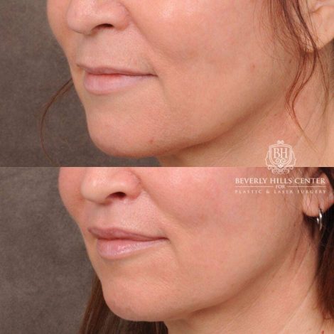 Beverly Hills Center Female Patient Before and After CUPID LIFT® Lip Lift