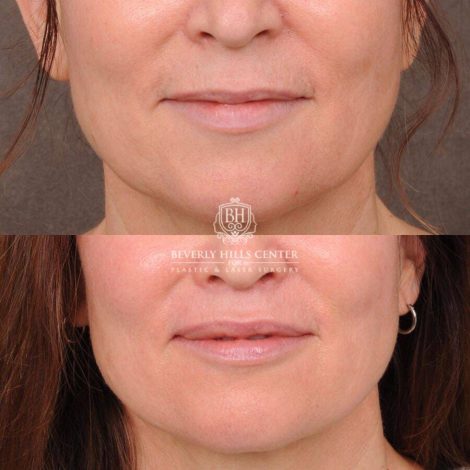 Beverly Hills Center Female Patient Before and After CUPID LIFT® Lip Lift