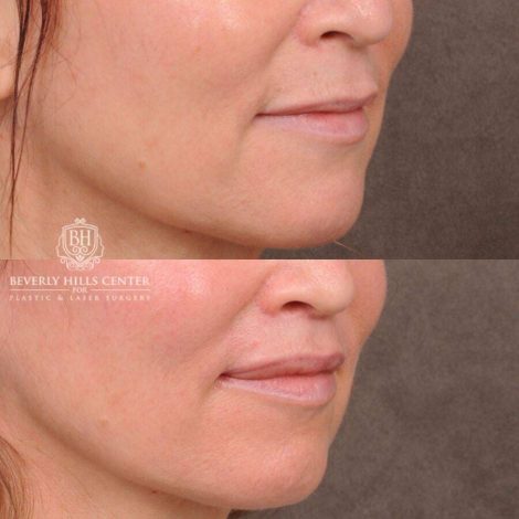 Beverly Hills Center Female Patient Before and After CUPID LIFT® Lip Lift