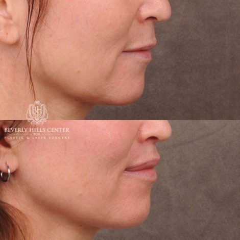 Beverly Hills Center Female Patient Before and After CUPID LIFT® Lip Lift