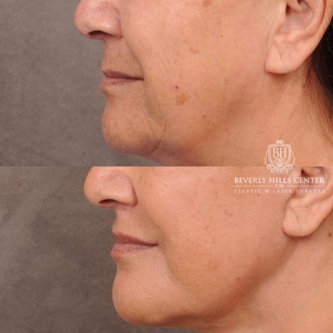 Beverly Hills Center Female Patient Before and After CUPID LIFT® Corner Lift & Co2 on Upper Lip Procedure