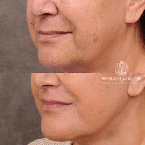 Beverly Hills Center Female Patient Before and After CUPID LIFT® Corner Lift & Co2 on Upper Lip Procedure