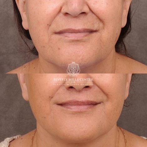 Beverly Hills Center Female Patient Before and After CUPID LIFT® Corner Lift & Co2 on Upper Lip Procedure