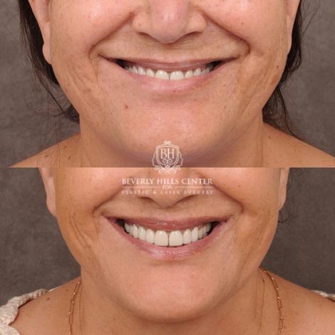 Beverly Hills Center Female Patient Before and After CUPID LIFT® Corner Lift & Co2 on Upper Lip Procedure