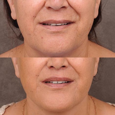 Beverly Hills Center Female Patient Before and After CUPID LIFT® Corner Lift & Co2 on Upper Lip Procedure