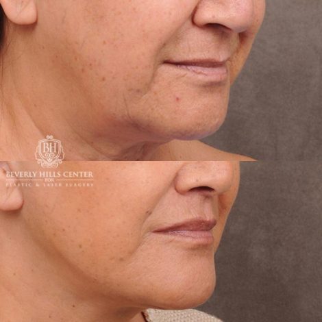 Beverly Hills Center Female Patient Before and After CUPID LIFT® Corner Lift & Co2 on Upper Lip Procedure
