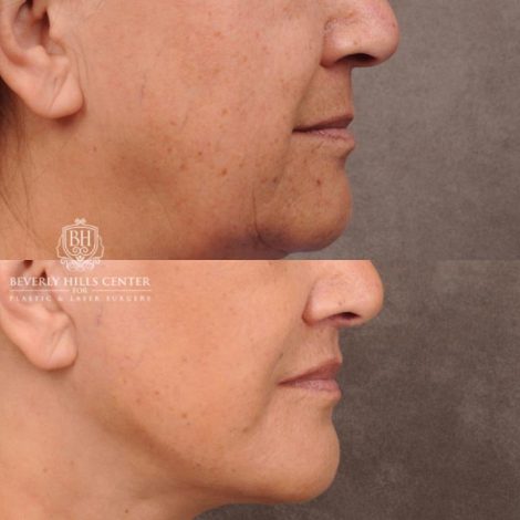 Beverly Hills Center Female Patient Before and After CUPID LIFT® Corner Lift & Co2 on Upper Lip Procedure