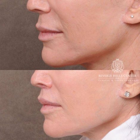Beverly Hills Center Female Patient Before and After CUPID LIFT® Lip Lift