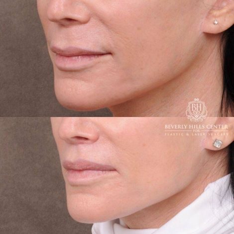 Beverly Hills Center Female Patient Before and After CUPID LIFT® Lip Lift