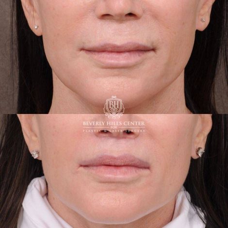 Beverly Hills Center Female Patient Before and After CUPID LIFT® Lip Lift