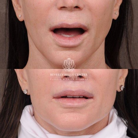 Beverly Hills Center Female Patient Before and After CUPID LIFT® Lip Lift