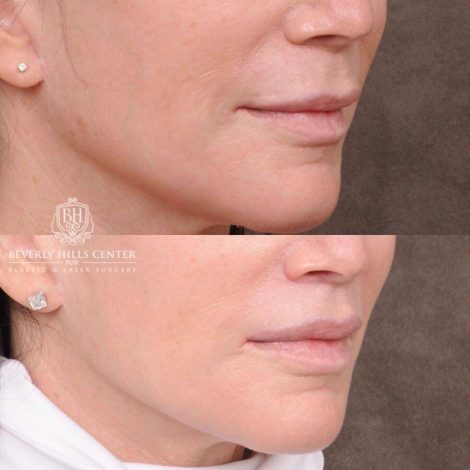 Beverly Hills Center Female Patient Before and After CUPID LIFT® Lip Lift