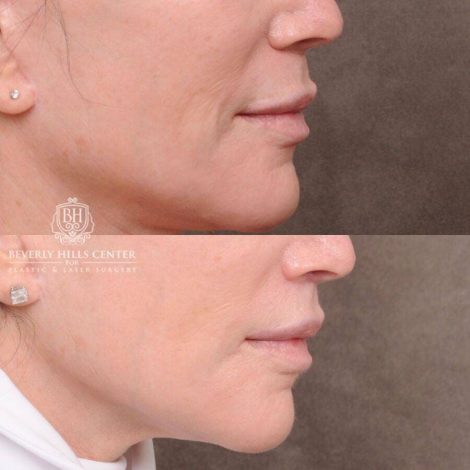 Beverly Hills Center Female Patient Before and After CUPID LIFT® Lip Lift