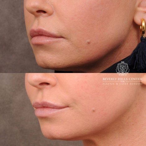 Beverly Hills Center Female Patient Before and After CUPID LIFT® Corner Lift