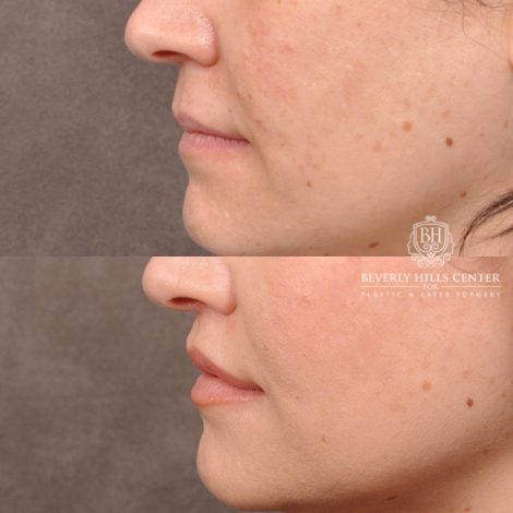 Beverly Hills Center Female Patient Before and After Deep Plane Upper Lip Lift Procedure