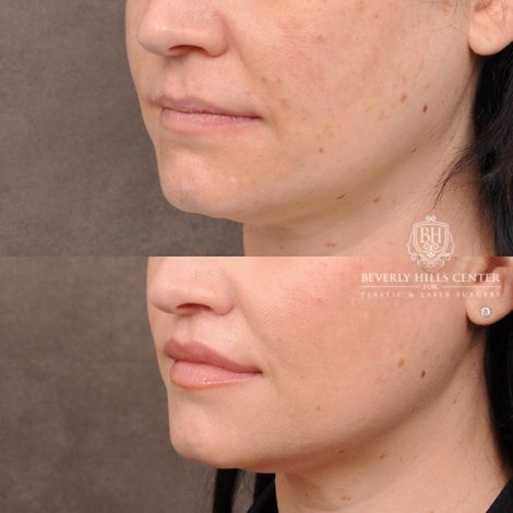 Beverly Hills Center Female Patient Before and After Deep Plane Upper Lip Lift Procedure
