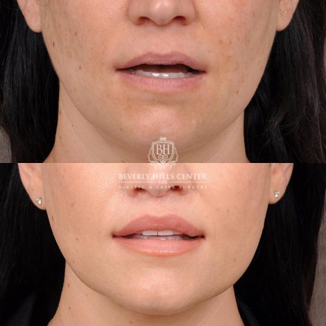 Beverly Hills Center Female Patient Before and After Deep Plane Upper Lip Lift Procedure