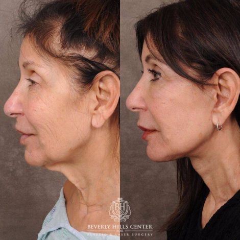 Beverly Hills Center Female Patient Before and After AuraLyft