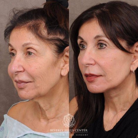 Beverly Hills Center Female Patient Before and After AuraLyft