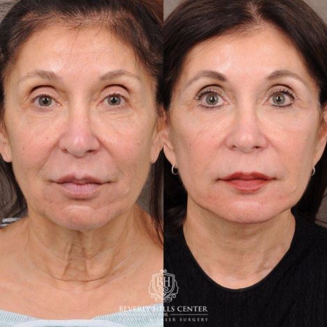 Beverly Hills Center Female Patient Before and After AuraLyft