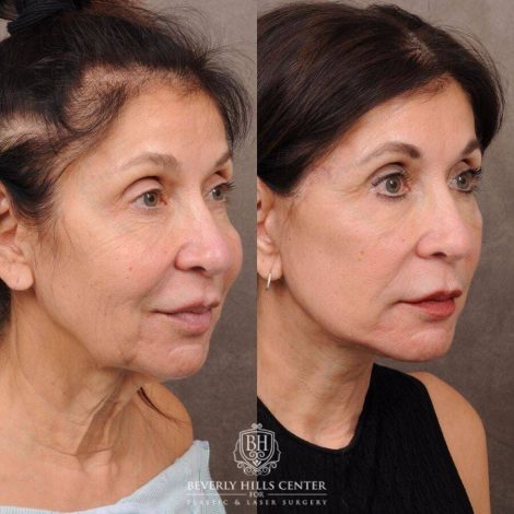 Beverly Hills Center Female Patient Before and After AuraLyft