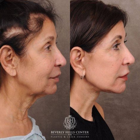Beverly Hills Center Female Patient Before and After AuraLyft