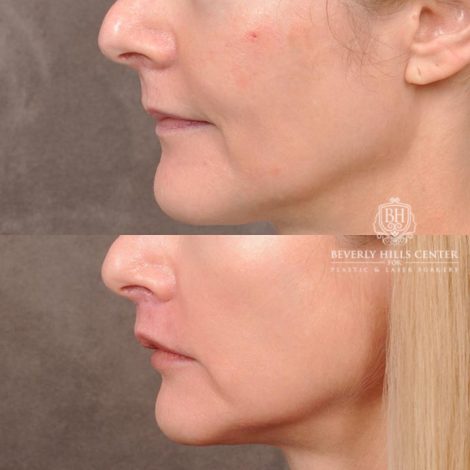 Beverly Hills Center Female Patient Before and After CUPID LIFT® Corner Lift Procedure