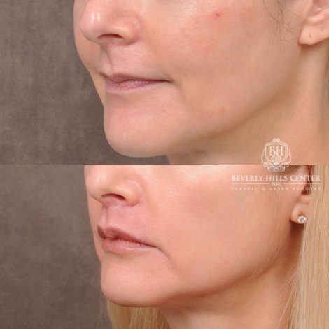 Beverly Hills Center Female Patient Before and After CUPID LIFT® Corner Lift Procedure