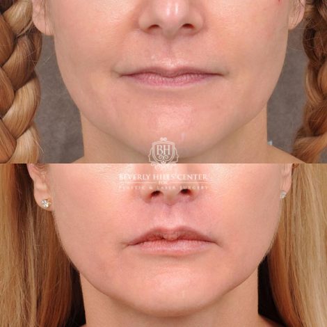 Beverly Hills Center Female Patient Before and After CUPID LIFT® Corner Lift Procedure