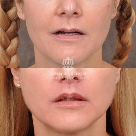 Beverly Hills Center Female Patient Before and After CUPID LIFT® Corner Lift Procedure