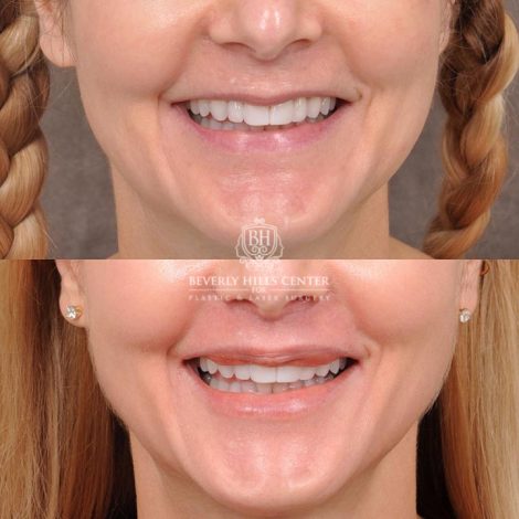 Beverly Hills Center Female Patient Before and After CUPID LIFT® Corner Lift Procedure