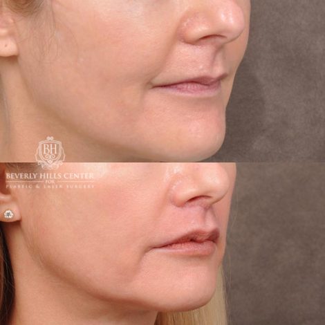 Beverly Hills Center Female Patient Before and After CUPID LIFT® Corner Lift Procedure