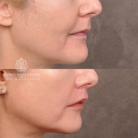 Beverly Hills Center Female Patient Before and After CUPID LIFT® Corner Lift Procedure