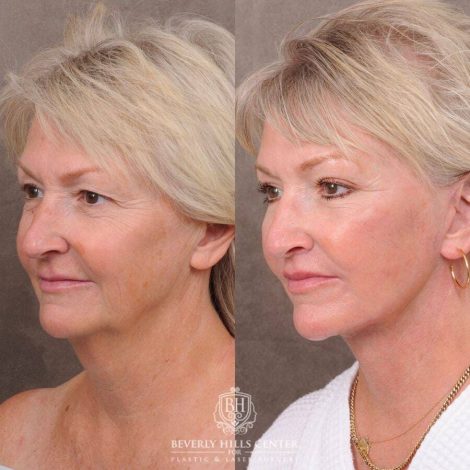 Beverly Hills Center Female Patient Before and After Comprehensive AuraLyft