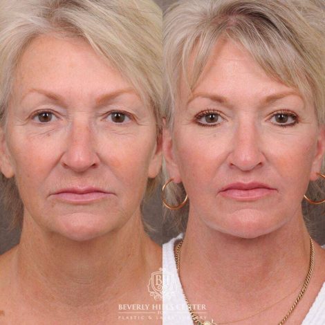 Beverly Hills Center Female Patient Before and After Comprehensive AuraLyft
