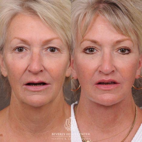 Beverly Hills Center Female Patient Before and After Comprehensive AuraLyft