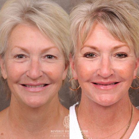 Beverly Hills Center Female Patient Before and After Comprehensive AuraLyft