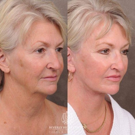Beverly Hills Center Female Patient Before and After Comprehensive AuraLyft