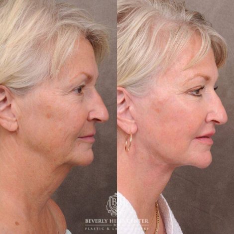 Beverly Hills Center Female Patient Before and After Comprehensive AuraLyft