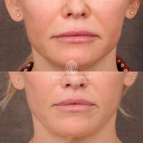 Beverly Hills Center Female Patient Before and After CUPID LIFT® Corner Lift & Profound (Lower Face)