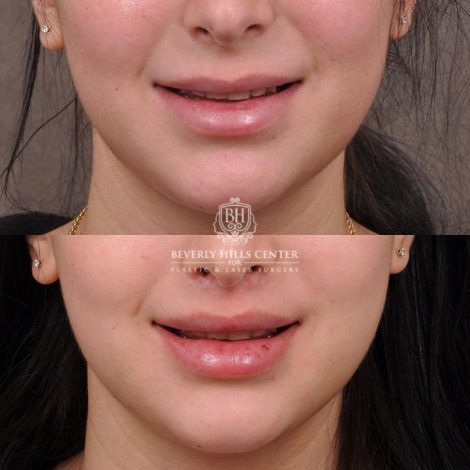 Beverly Hills Center Female Patient Before and After Lip Lift