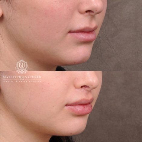Beverly Hills Center Female Patient Before and After Lip Lift