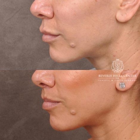 Beverly Hills Center Female Patient Before and After Lip Lift following Dissolver Procedure
