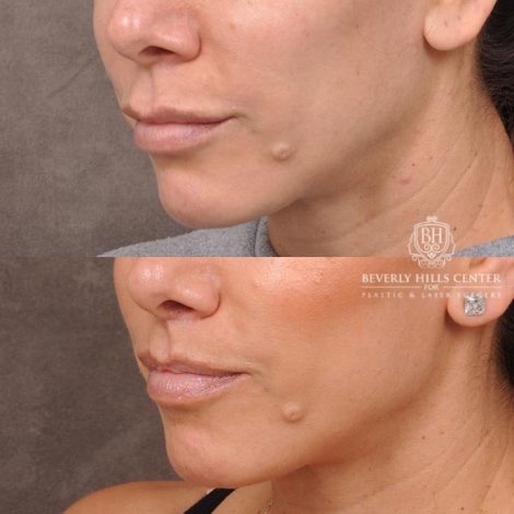 Beverly Hills Center Female Patient Before and After Lip Lift following Dissolver Procedure