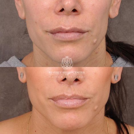 Beverly Hills Center Female Patient Before and After Lip Lift following Dissolver Procedure
