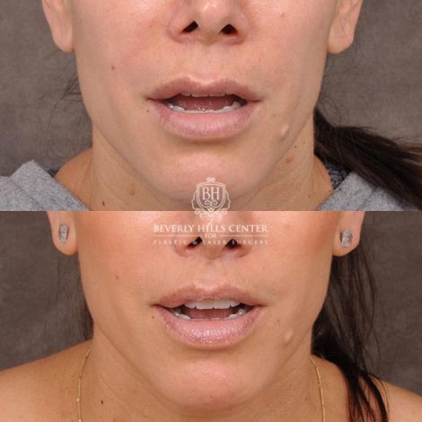 Beverly Hills Center Female Patient Before and After Lip Lift following Dissolver Procedure