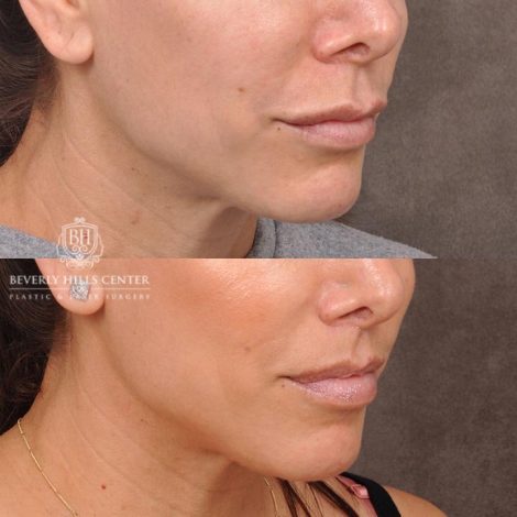 Beverly Hills Center Female Patient Before and After Lip Lift following Dissolver Procedure