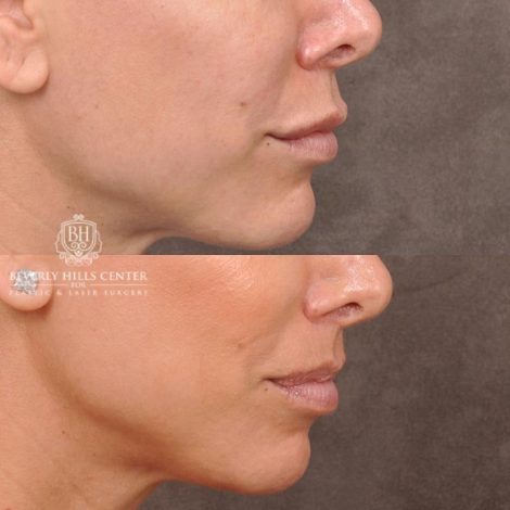Beverly Hills Center Female Patient Before and After Lip Lift following Dissolver Procedure