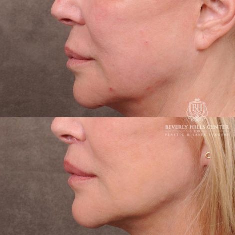 Beverly Hills Center Female Patient Before and After Lip Lift with Mucosal Reduction Procedure