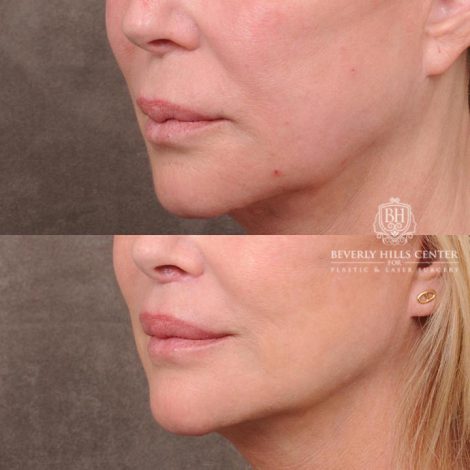 Beverly Hills Center Female Patient Before and After Lip Lift with Mucosal Reduction Procedure